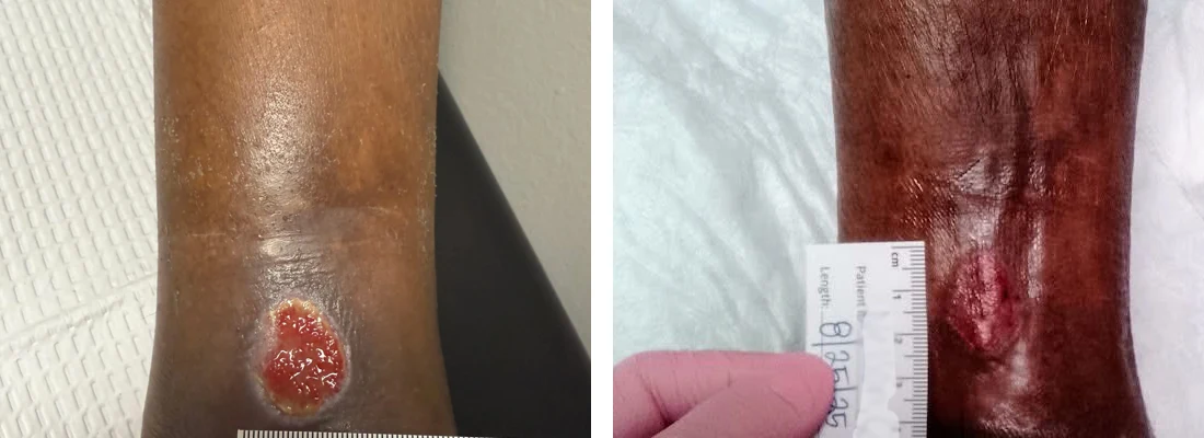 Chronic Pain Conway AR Ankle Wound Before And After A before and after of an ankle wound healing.
